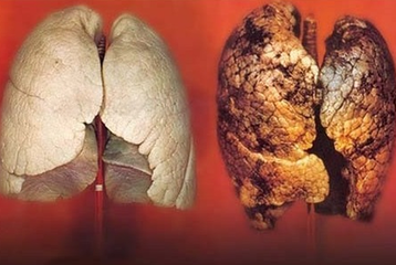 肺癌